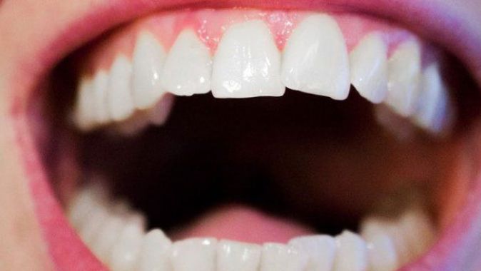 Dişlerinde yamukluk sorunu olanlar dikkat