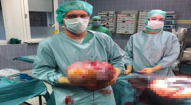 Kadının yumurtasından 10.2 kilo ağırlığında tümör çıktı