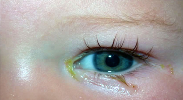 Çocuklarda göz çapaklanması neden olur, nasıl geçer? | Göz çapağı nasıl temizlenir?