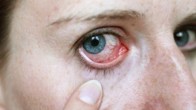 Gözde kırmızılık niye olur, gözlerdeki kırmızılık hastalık belirtisi mi?