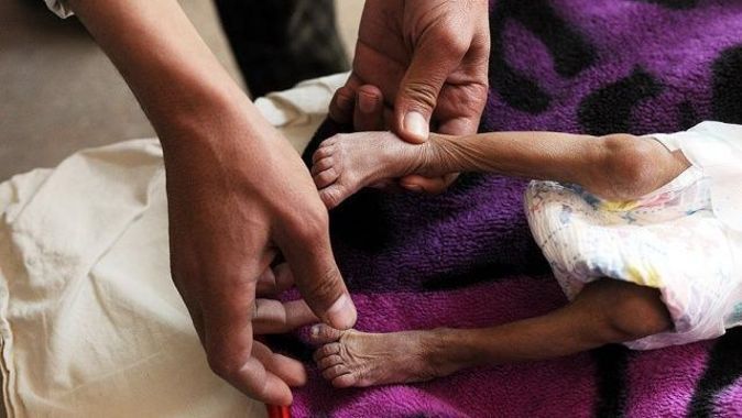 Yemen&#039;deki difteri salgınında ölü sayısı artıyor