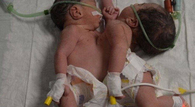 Konya’da doğan yapışık ikizler ameliyatla ayrıldı, biri kurtarılamadı