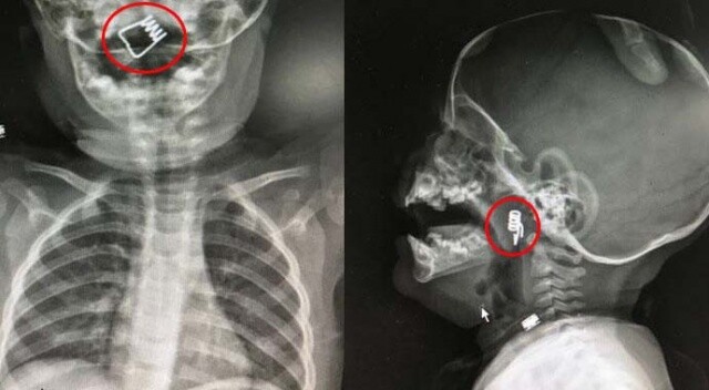 1 yaşındaki bebeğin boğazında tespit edildi