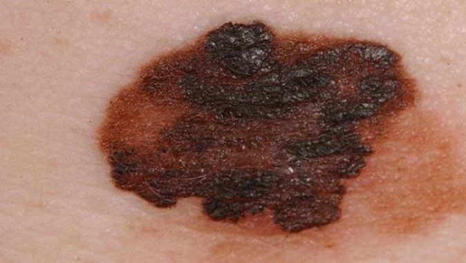 “Malign melanom, ölüm oranlarını yüzde 44 arttırıyor”