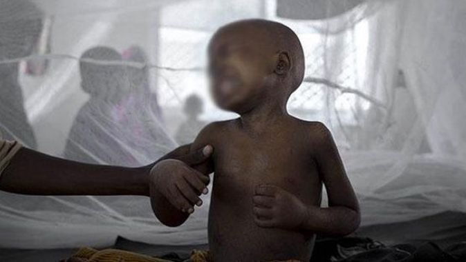 Etiyopya&#039;da kolera salgını: 16 ölü