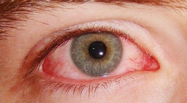 Göz kanlanması göz tümörü habercisi olabilir
