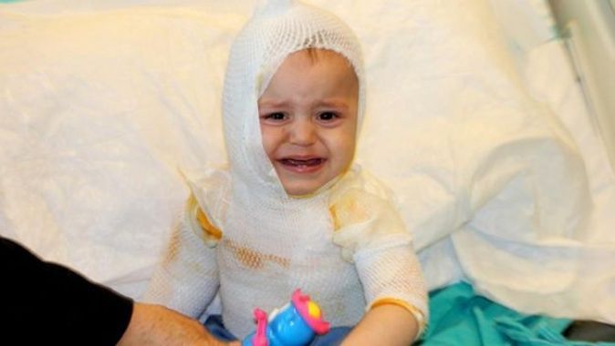 Üzerine kaynar süt dökülen 1 yaşındaki çocuk feci şekilde yandı