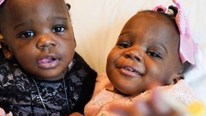 Ayrılıkların en güzeli: Kamerunlu yapışık ikizler Türkiye’de yeniden doğdu