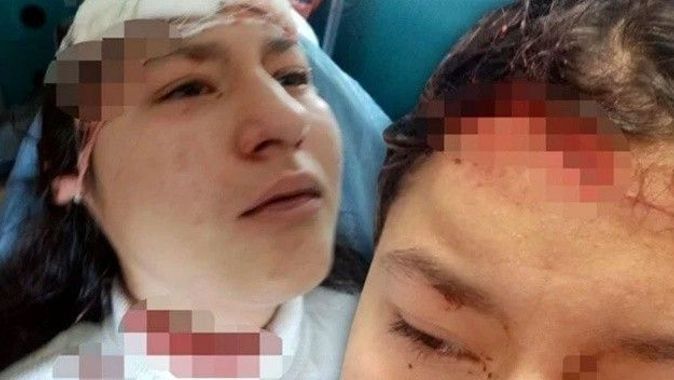 14 yaşındaki çocuk selfie çekilirken köpeklerin saldırısına uğradı