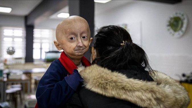 Türkiye&#039;de sadece 4 kişide var: 9 yaşındaki Veysel erken yaşlanma hastalığıyla mücadele ediyor