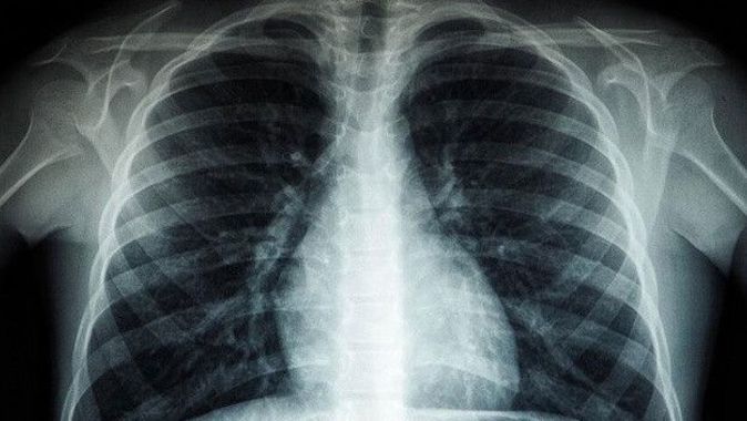 Soluyarak havadan alıyoruz… İlk kez canlı insan akciğerinde mikroplastik bulundu!