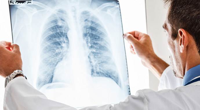 Akciğer kanserinin belirtileri nelerdir