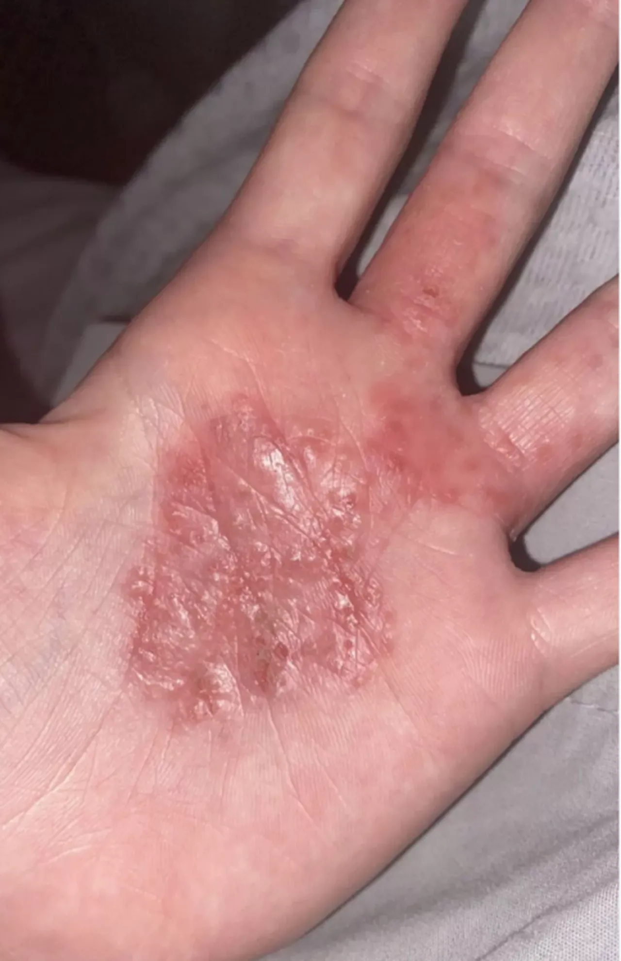 Darcie Hamilton, aşırı terleme hastalığı ile mücadele ediyor