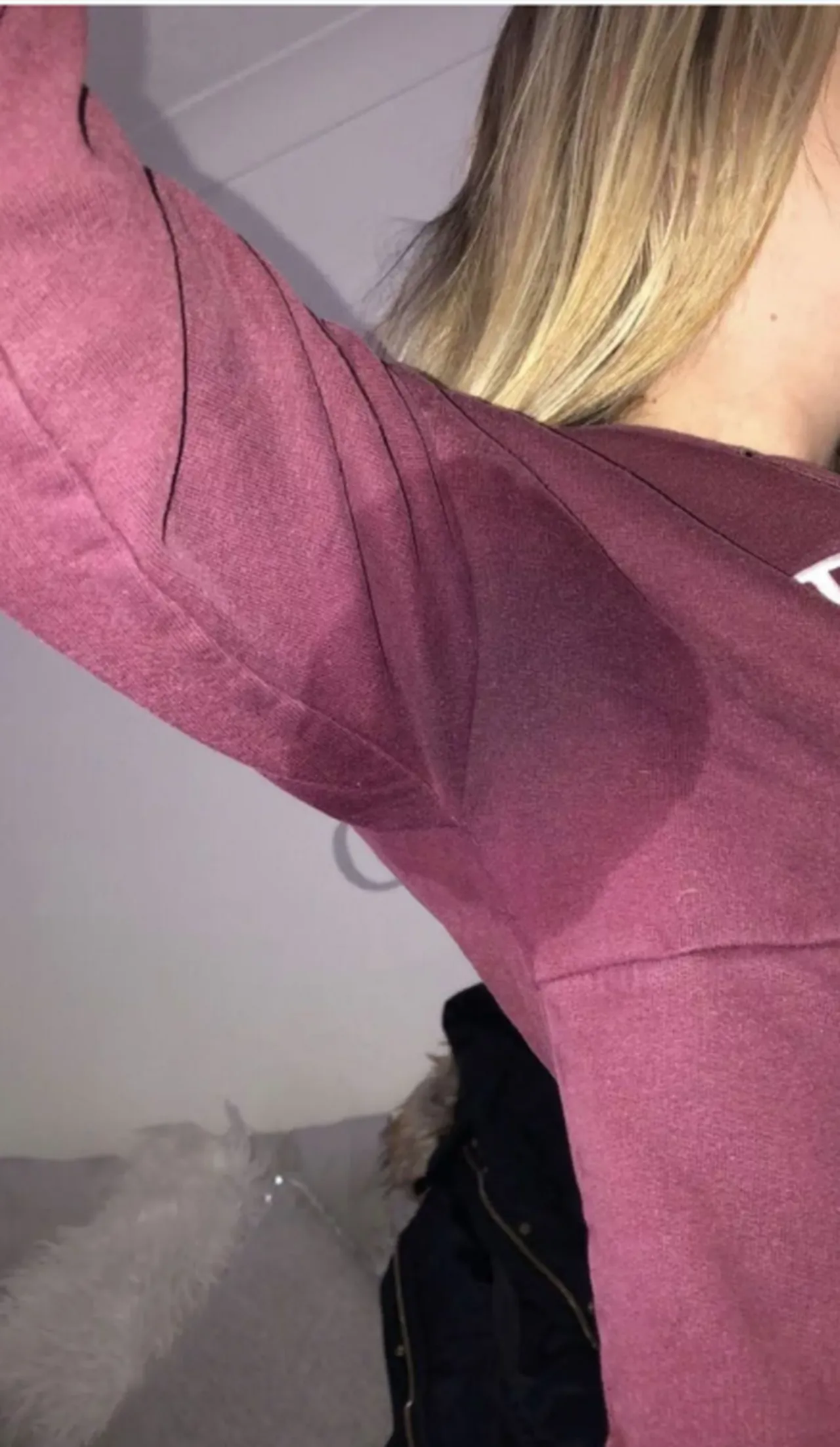 Darcie Hamilton, aşırı terleme hastalığı ile mücadele ediyor