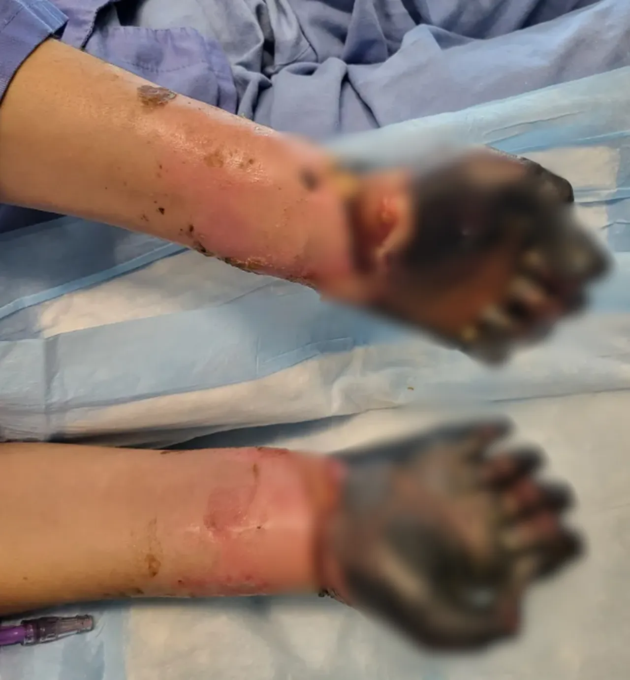 Ağrı şikayetini önemsemedi, acı gerçek yoğun bakımda ortaya çıktı! El ve ayakları ampute edildi