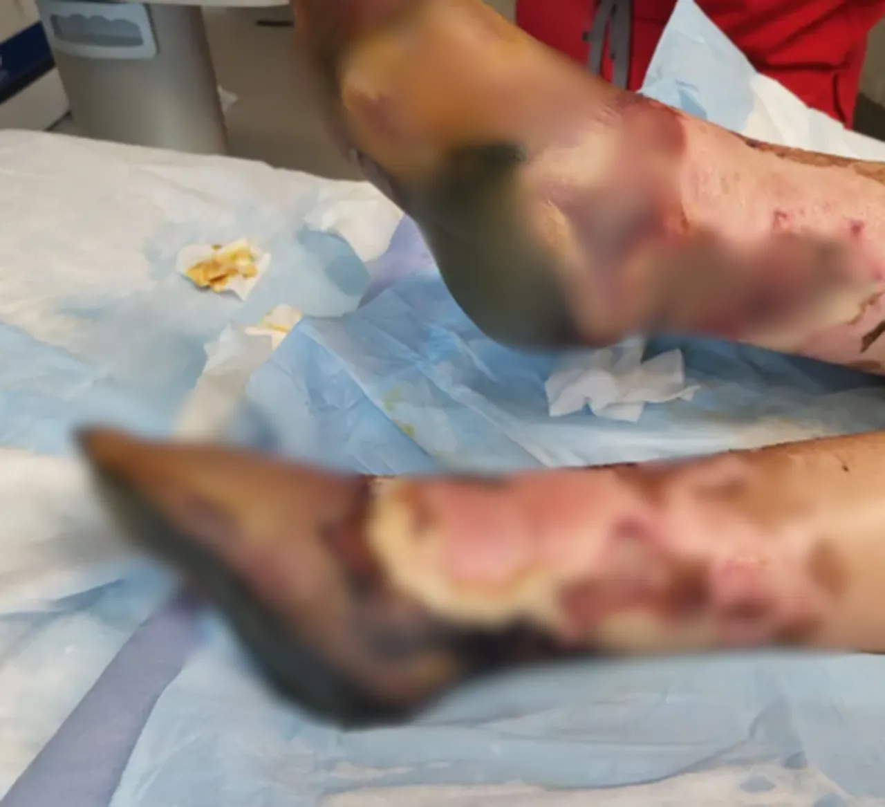 Ağrı şikayetini önemsemedi, acı gerçek yoğun bakımda ortaya çıktı! El ve ayakları ampute edildi