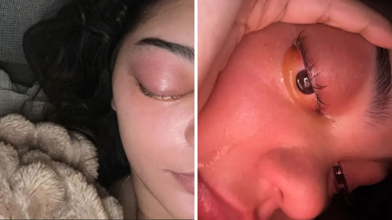 Soğuk algınlığı sandı, gözünden iltihap aktı! 9 saatlik operasyonla hayata tutunmayı başardı