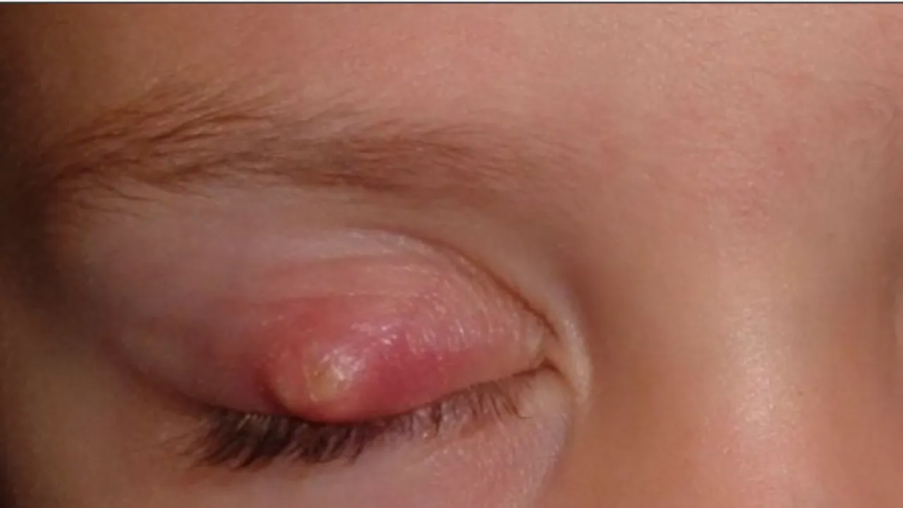 Soğuk algınlığı sandı, gözünden iltihap aktı! 9 saatlik operasyonla hayata tutunmayı başardı