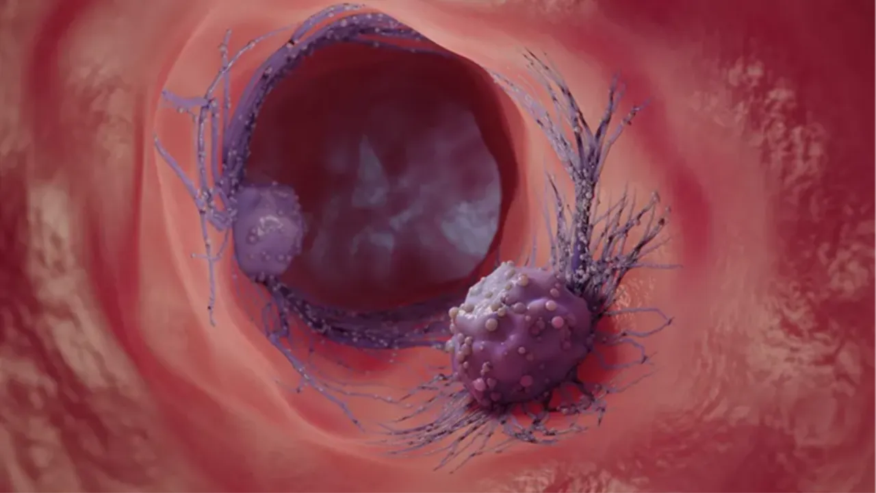 Bir yıl ömür biçilen hastalar tamamen iyileşti! Multiple Miyelom kanseri için en iyi tedavi yöntemi keşfedildi