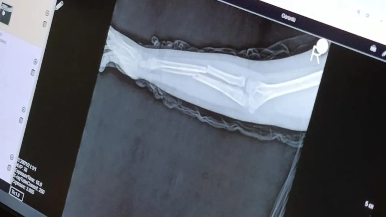 İstanbul'da akran zorbalığı! 9 yaşındaki çocuk, 8 yaşındaki arkadaşının kolunu kırdı, sözleri kan dondurdu