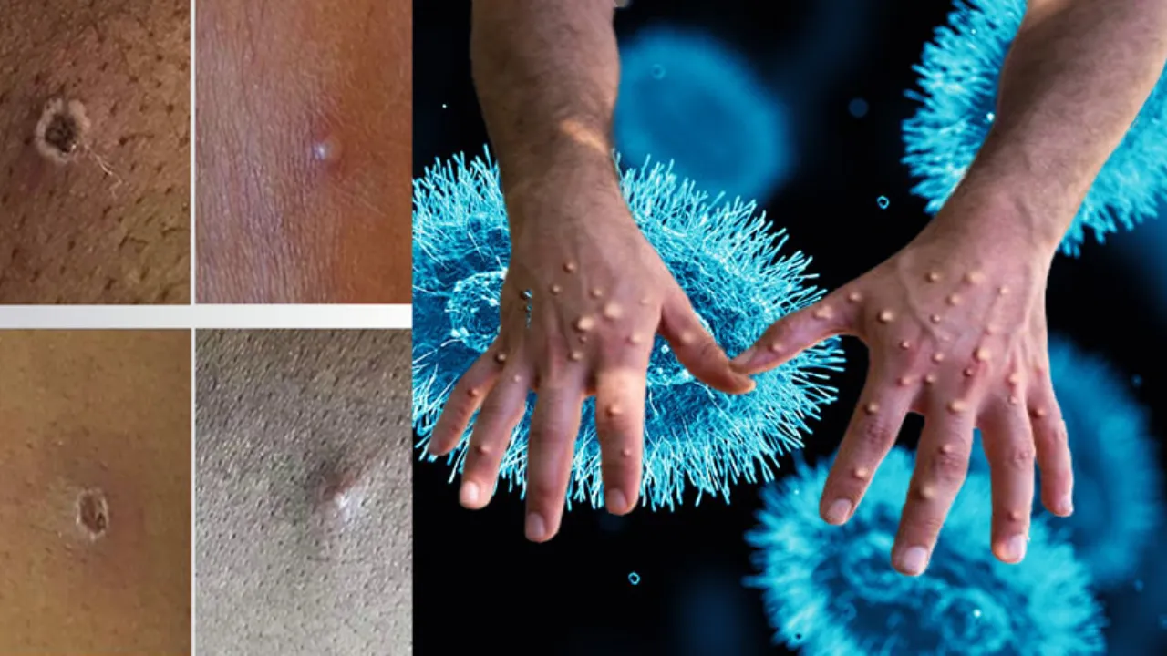 Korkutan maymun çiçeği gelişmesi! İki virüs birleşerek yayılıyor