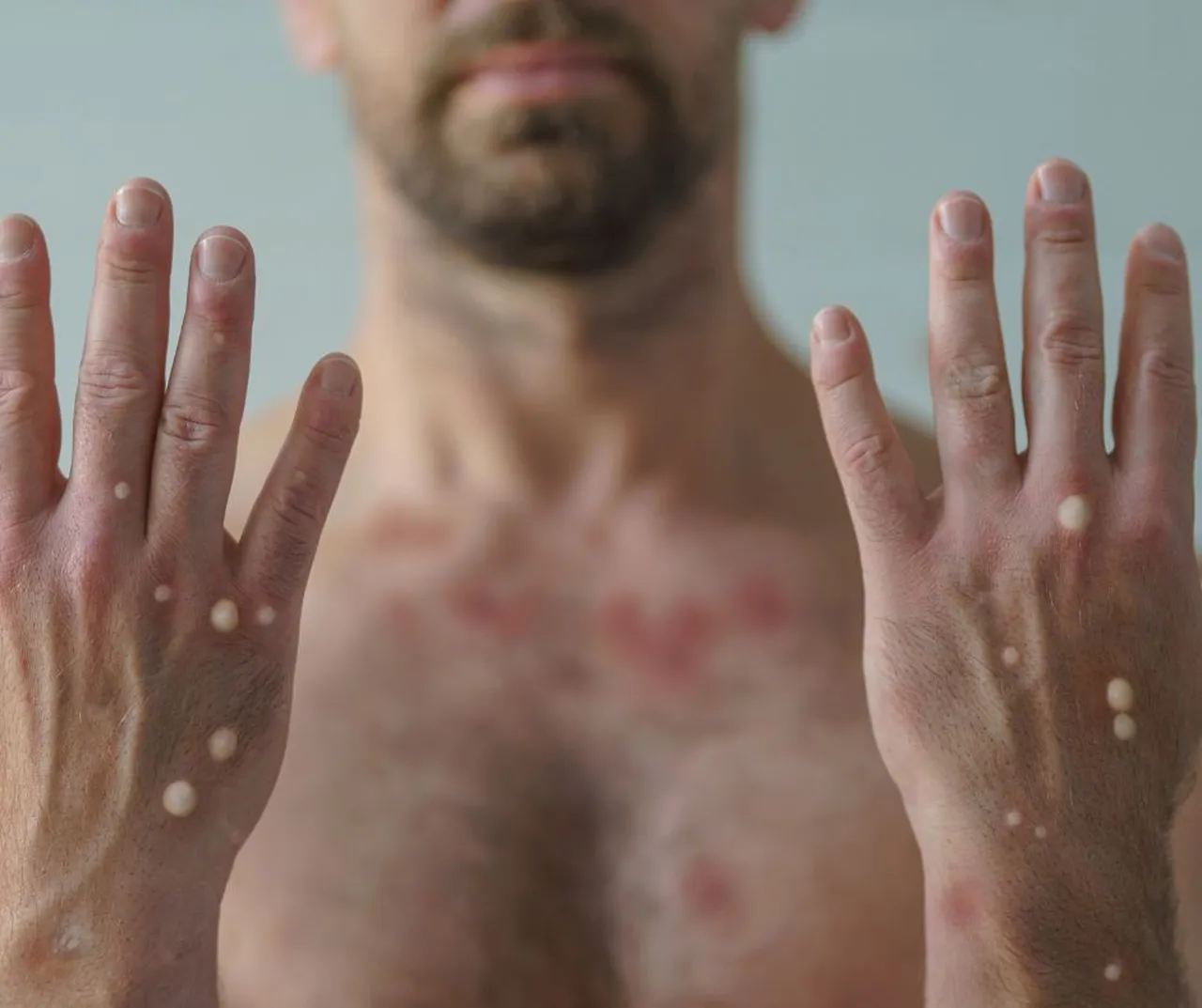 Korkutan maymun çiçeği gelişmesi! İki virüs birleşerek yayılıyor