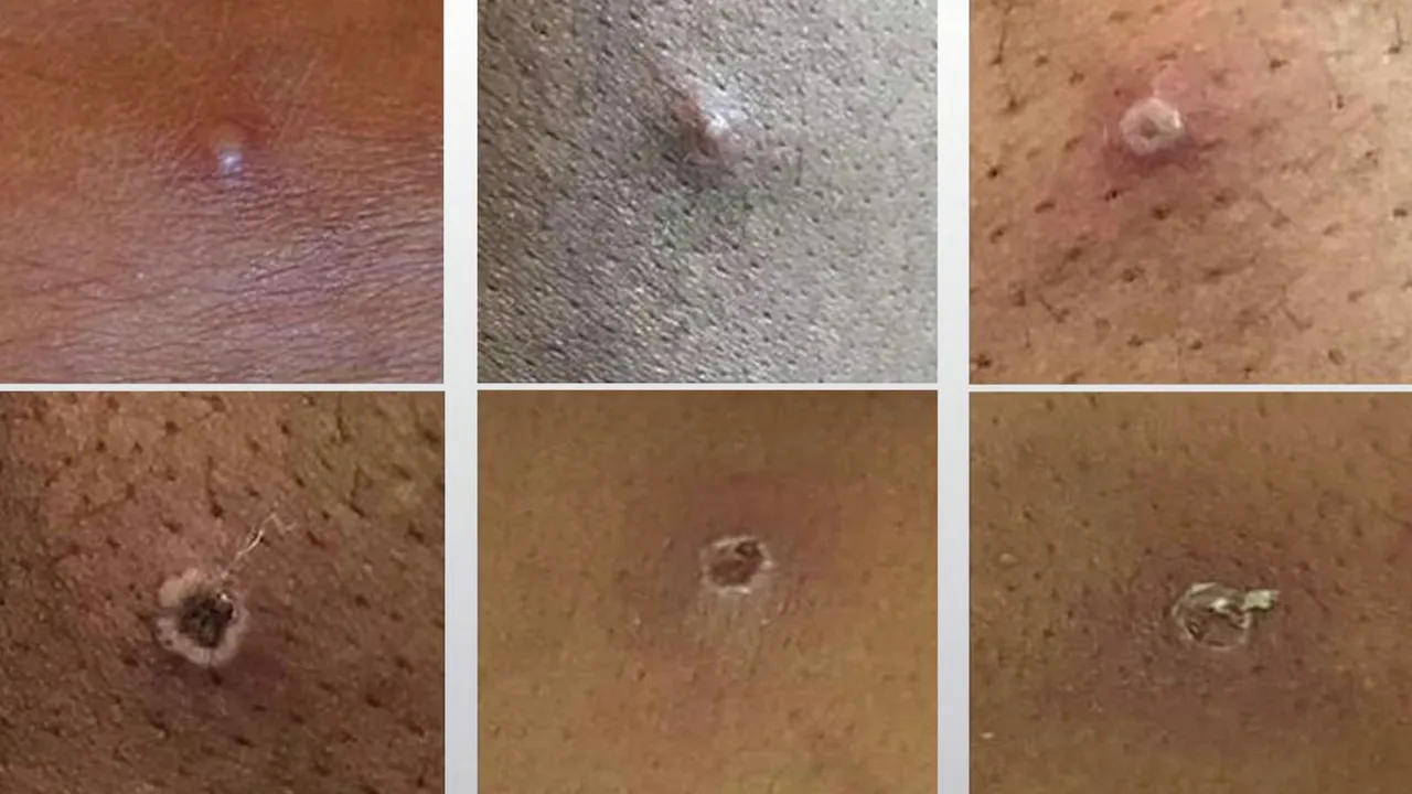 Korkutan maymun çiçeği gelişmesi! İki virüs birleşerek yayılıyor