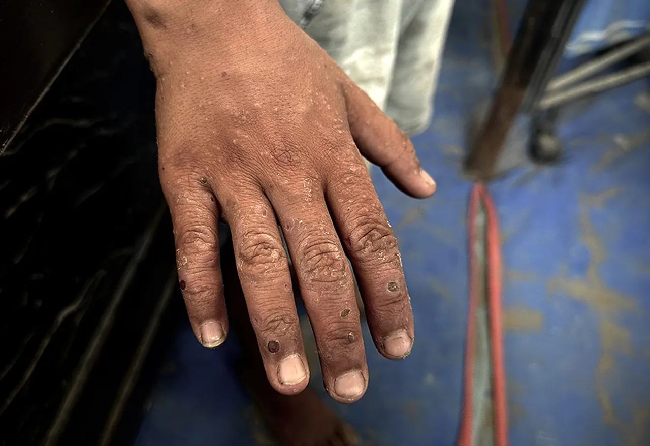 Son 30 yıldır vakalar yükselişte