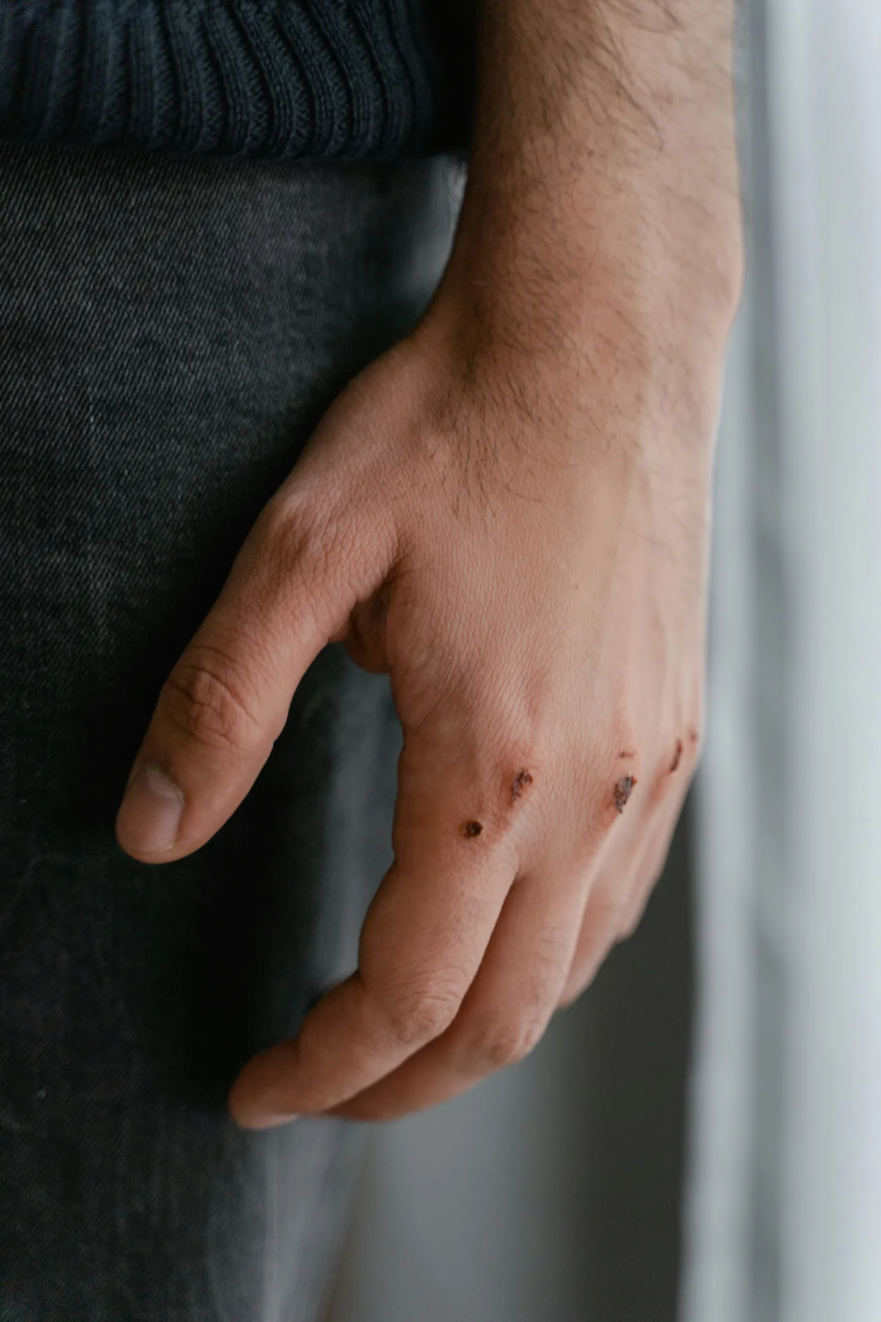 Son 30 yılda uyuz vakaları pik yaptı! Belirtileri 2. haftada ortaya çıkıyor, 3 yıl süren var