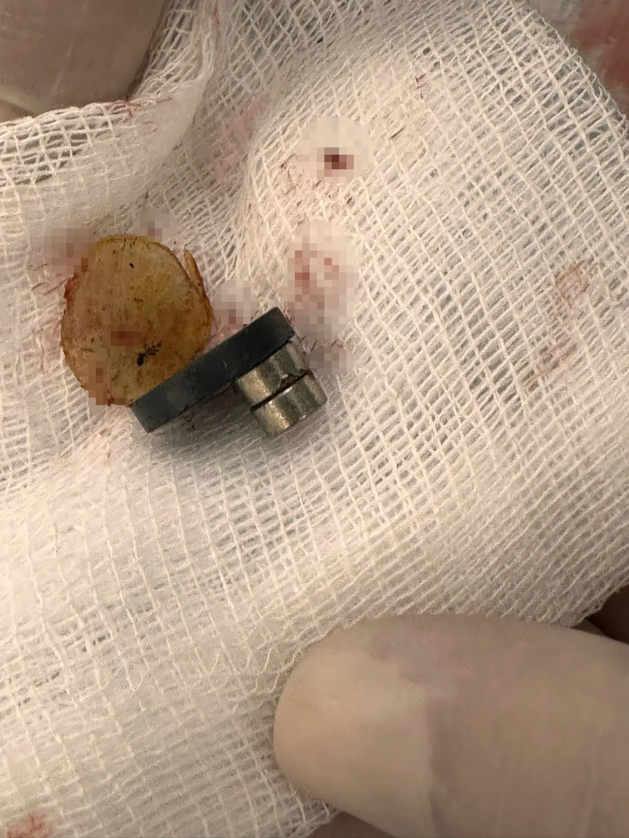 Mıknatıs yutan bebeğin bağırsağı delindi