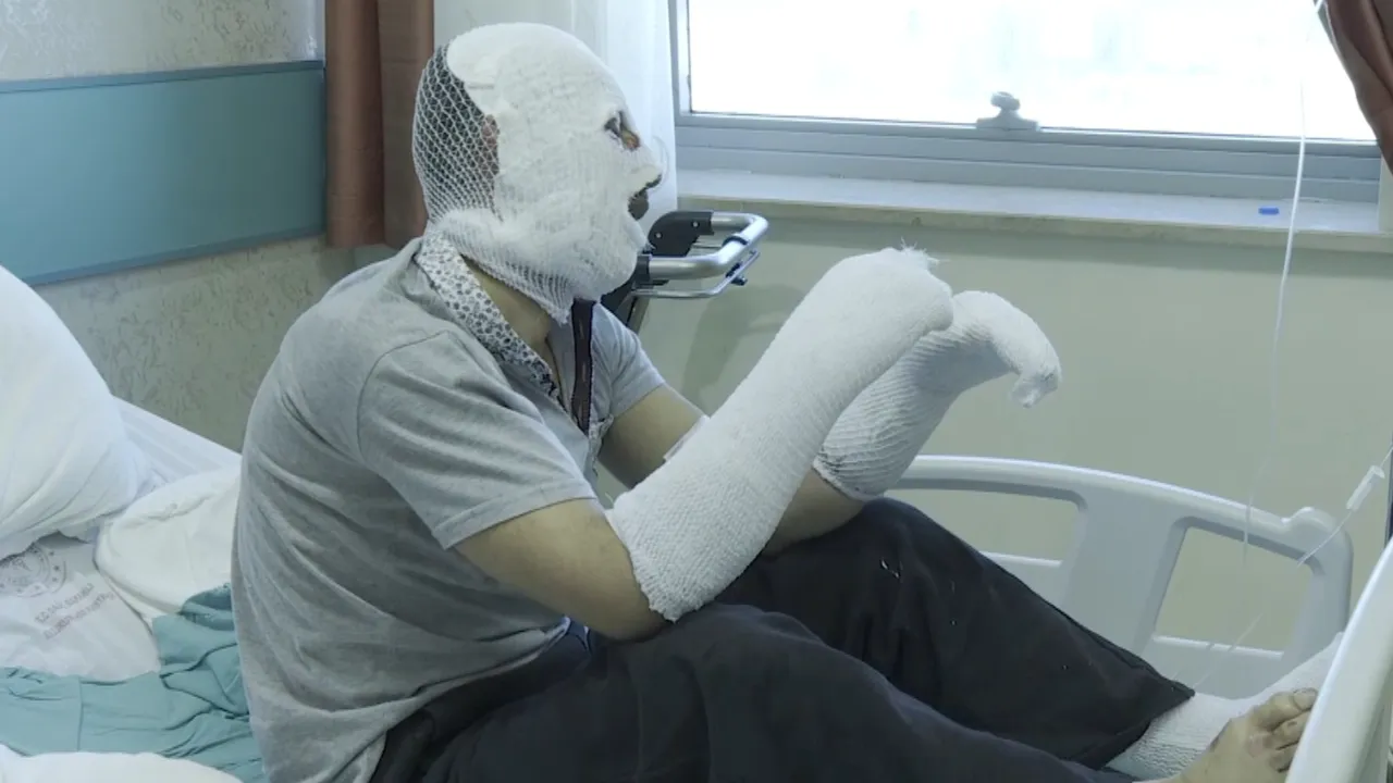 Çay demlerken vücudunun yüzde 26'sı yandı! 