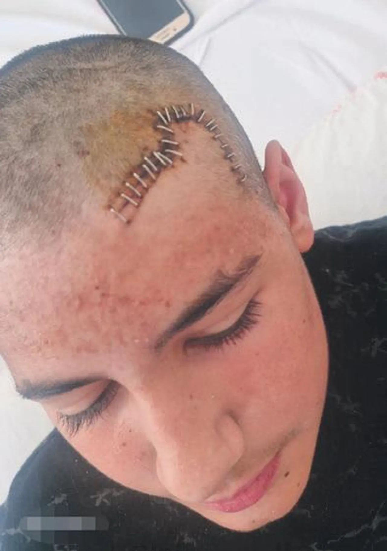 Kırılan kafatası titanyum parçalar ile birleştirildi