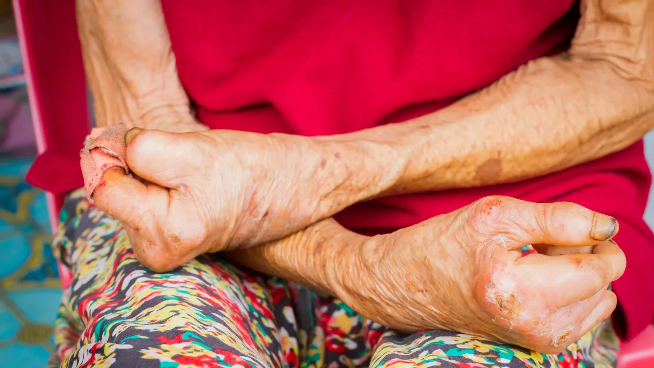 Hırvatistan ve Romanya'da cüzzam paniği! 44 yıl sonra ilk kez görüldü, yetkililer alarma geçti