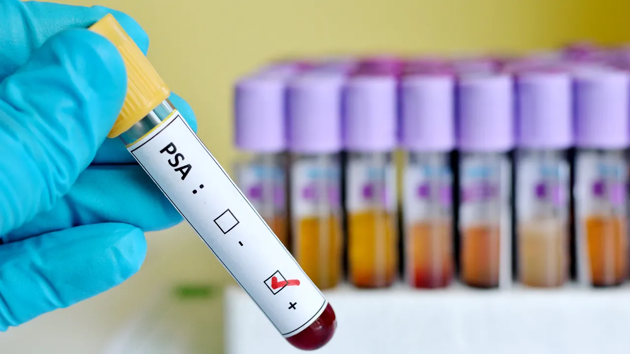 Türk bilim kadını buldu! Prostat kanserine karşı yeni bir umut