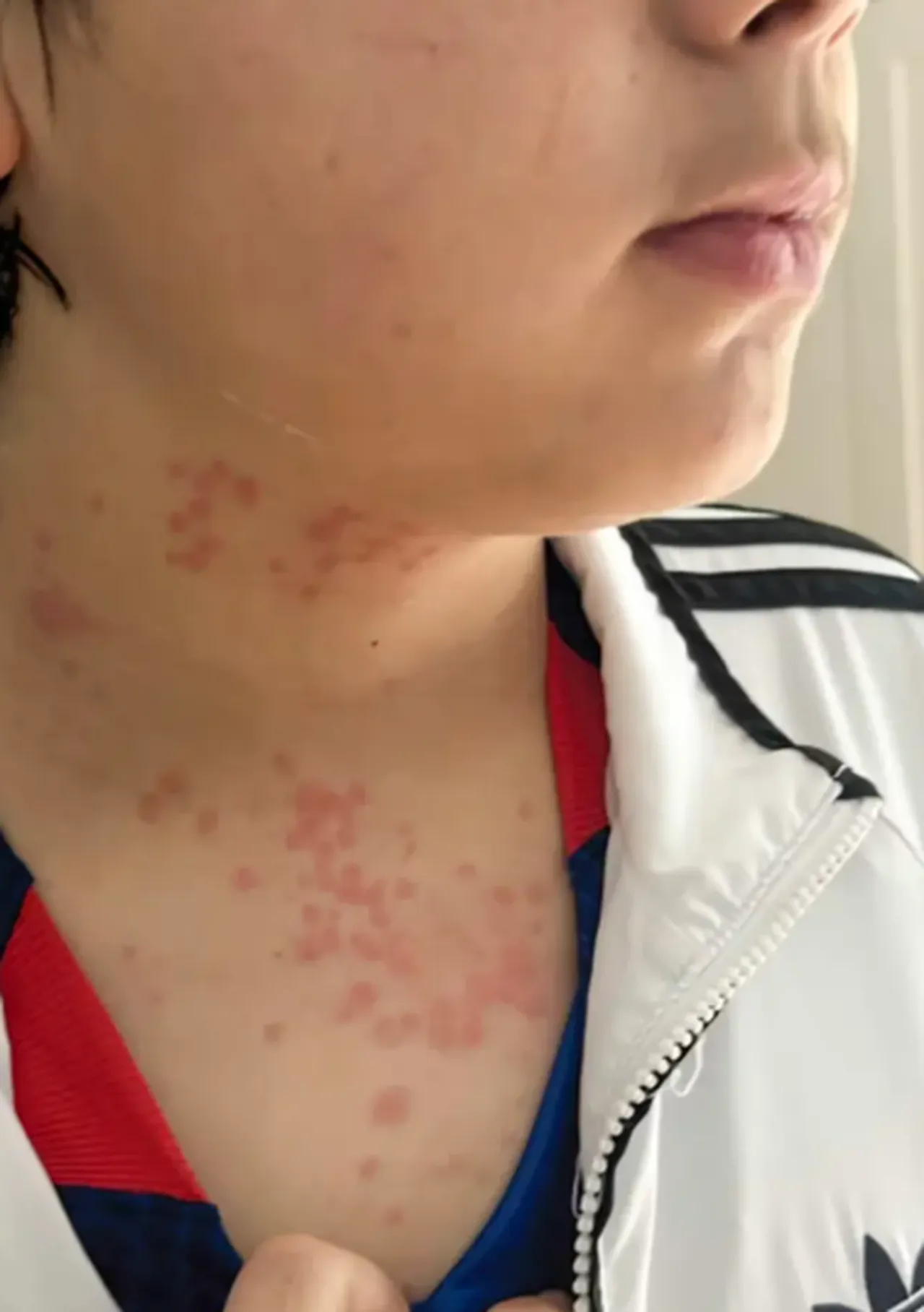 Dev havayolu şirketine tahtakurusu davası! Aile kabusu yaşadı: Üzerimde geziyorlardı