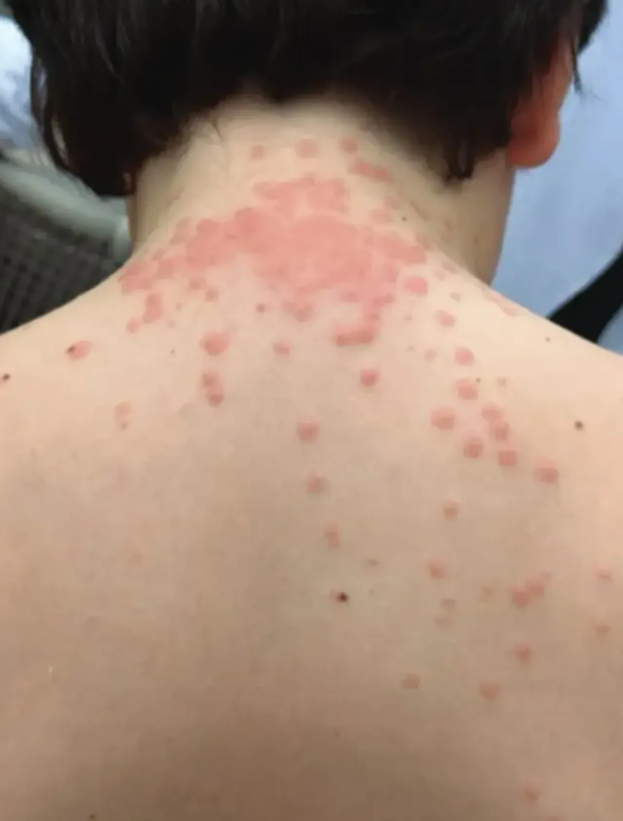 Dev havayolu şirketine tahtakurusu davası! Aile kabusu yaşadı: Üzerimde geziyorlardı