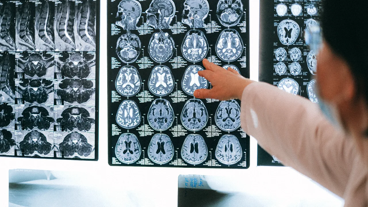 Bilim insanları tarih verdi! Demansı tamamen iyileştirecek kür geliyor