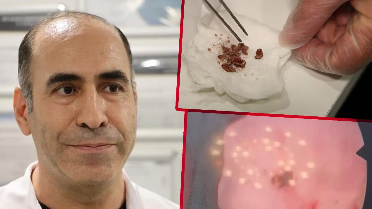 Şaşırtan olay! Estetik için gitti, ameliyatta burnundan taş çıktı