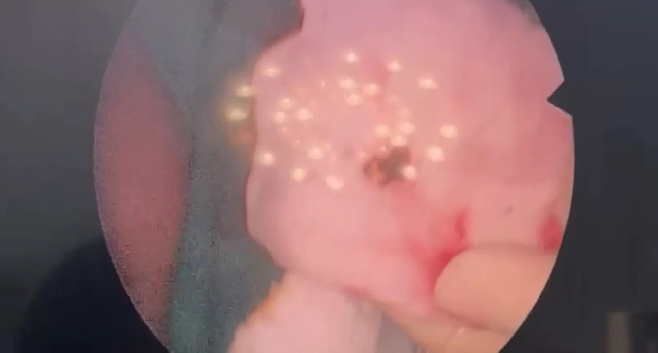 Şaşırtan olay! Estetik için gitti, ameliyatta burnundan taş çıktı