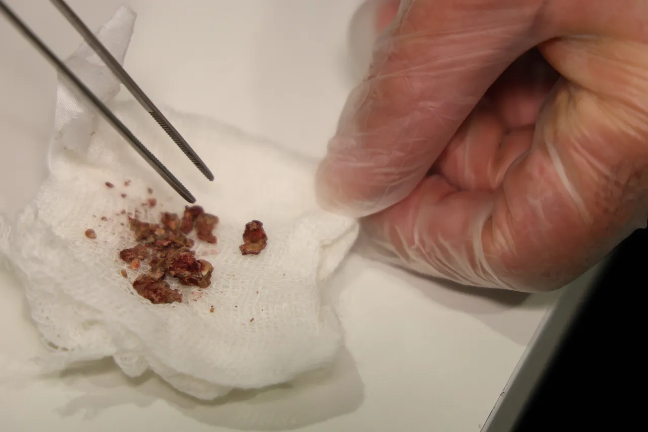 Şaşırtan olay! Estetik için gitti, ameliyatta burnundan taş çıktı