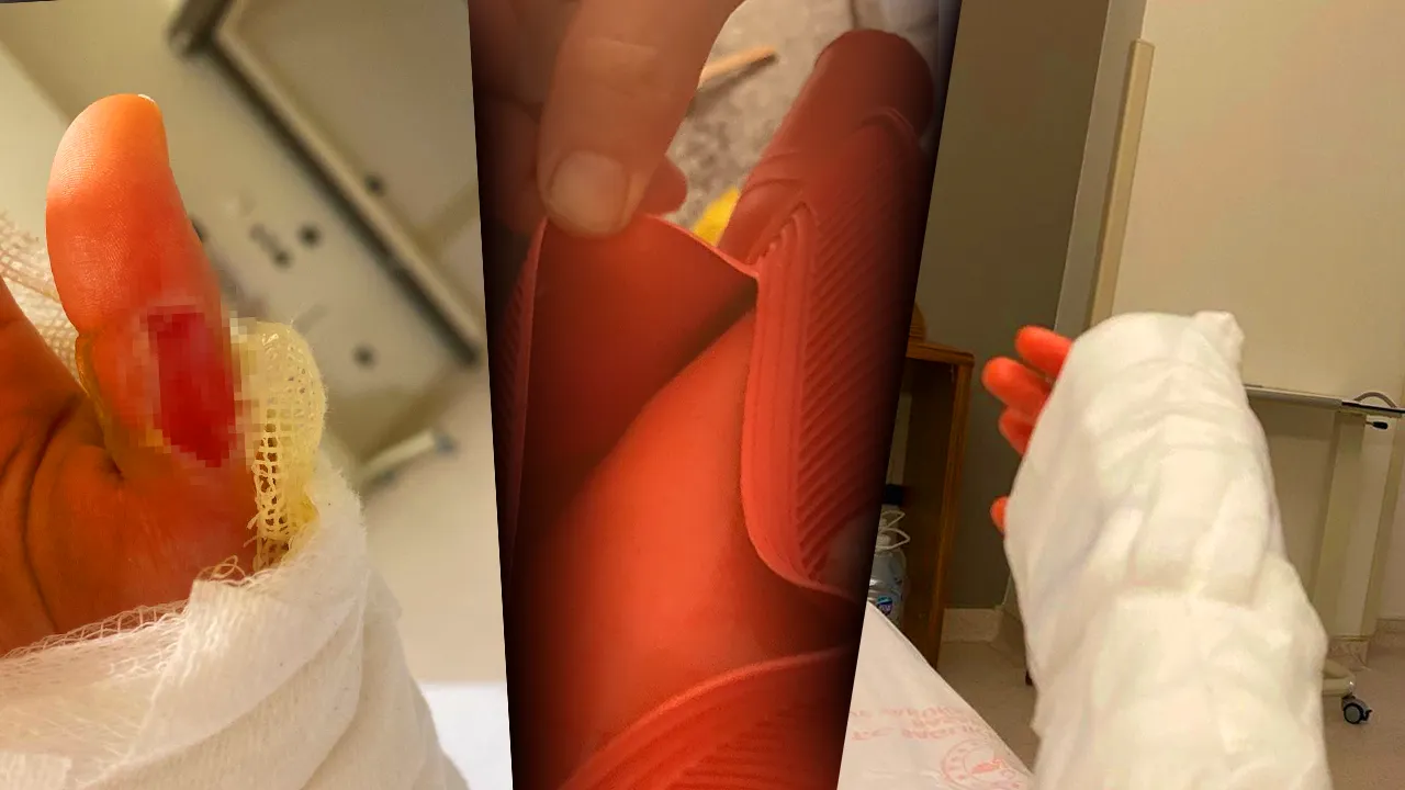 Sıcak su torbası dehşet saçtı! Vücudunun yüzde 25'i yanan genç kız: O acının tarifi yok