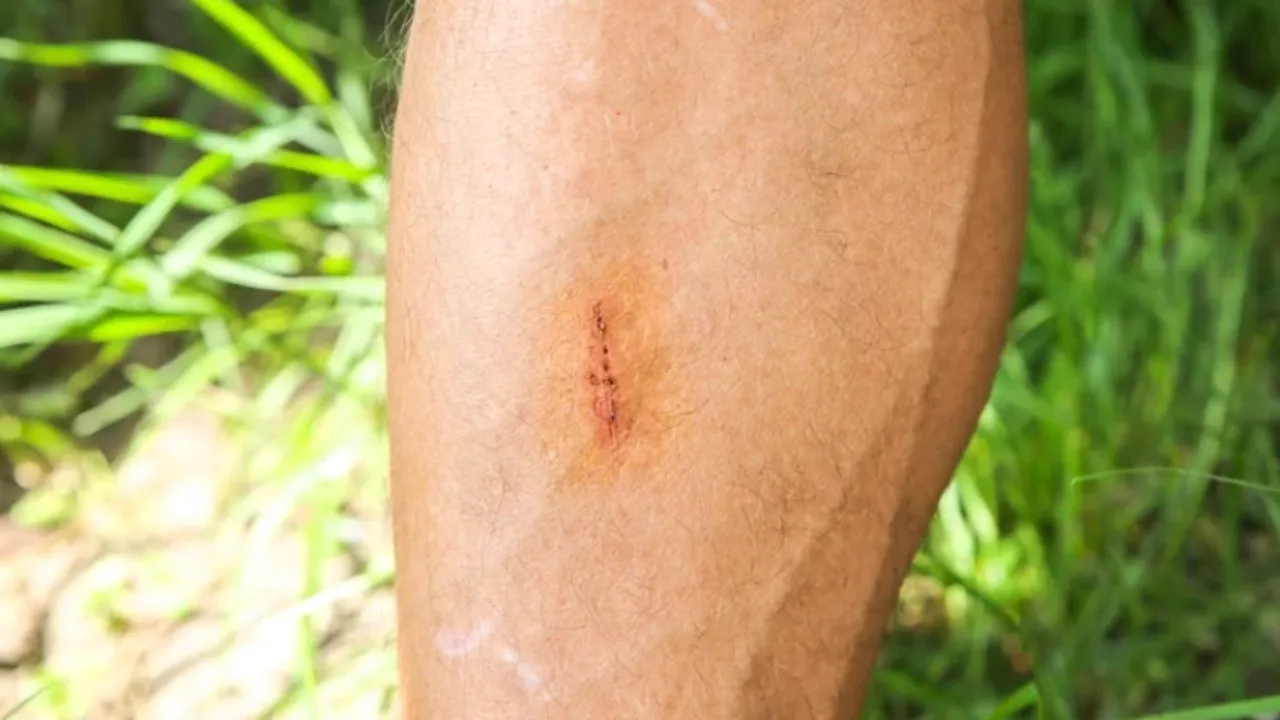 24 saat içinde öldüren enfeksiyon yayılıyor! Kırmızı leke diye geçmeyin
