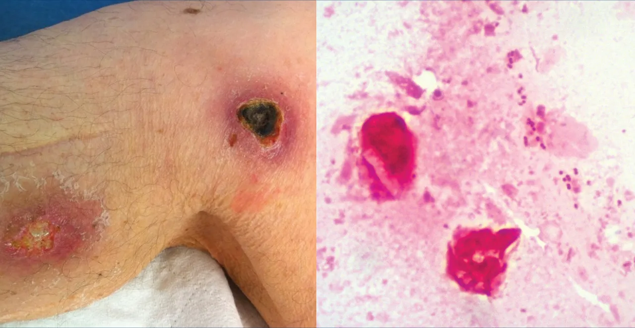 Ölüm oranı yüzde 50'den fazla! İlaçların etki etmediği mantarın vakaları hızla artıyor