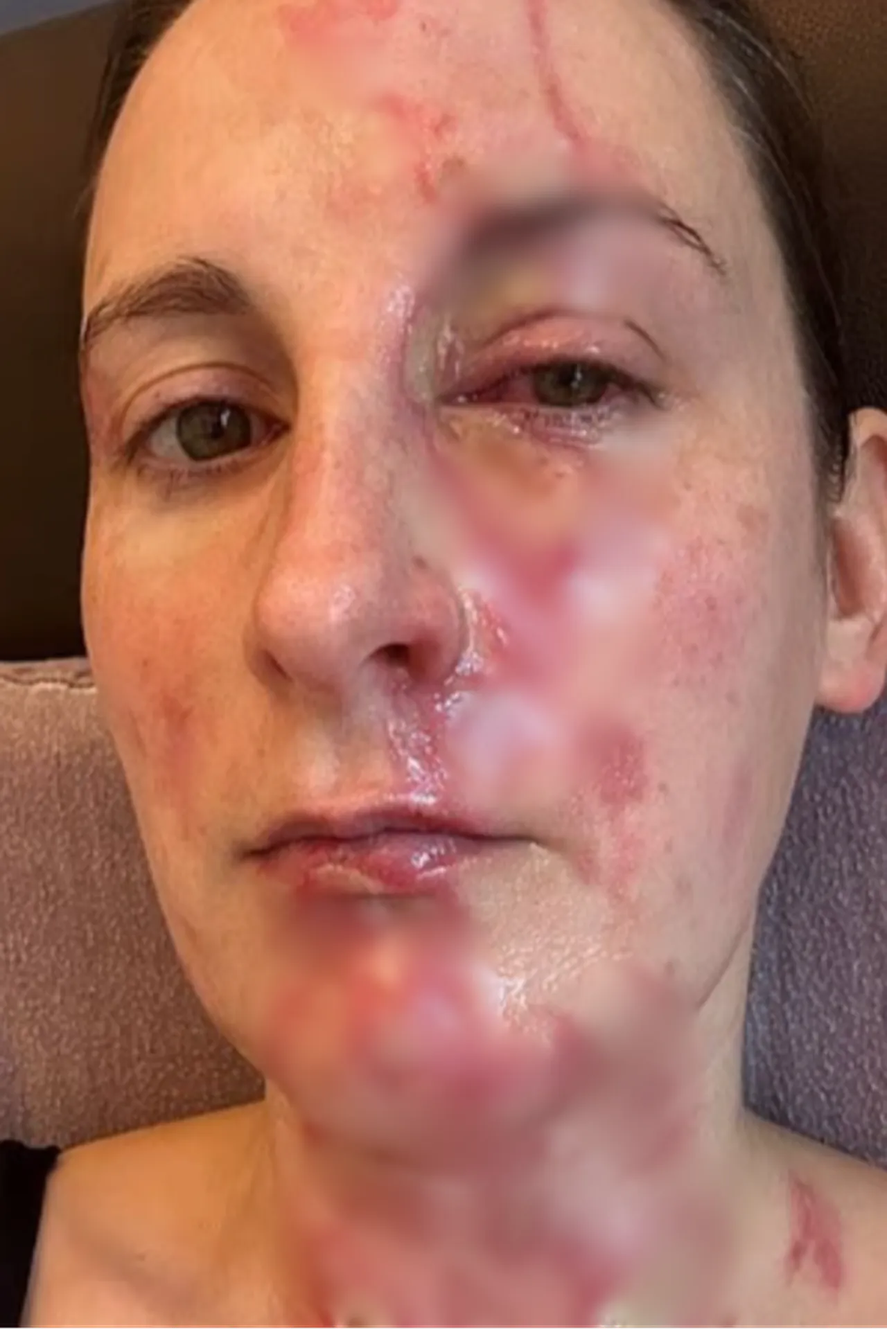 Görülmemiş blender faciası! Kapak fırladı, sıcak sos fışkırdı: Deri nakli gerekebilir