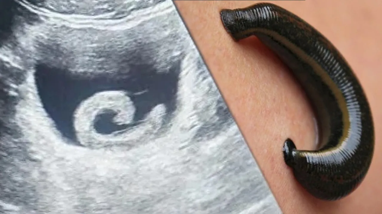 Akıl almaz olay! Genç adamın mesanesinde sülük bulundu