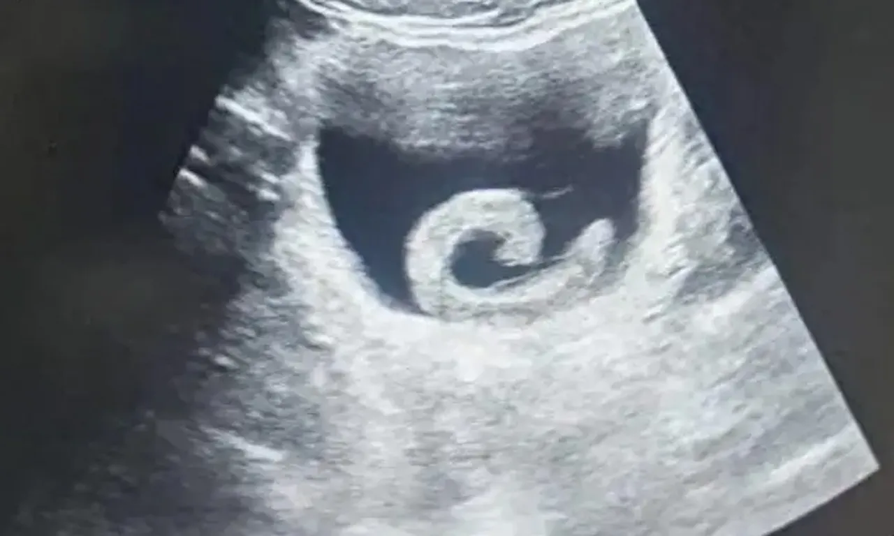 Akıl almaz olay! Genç adamın mesanesinde sülük bulundu