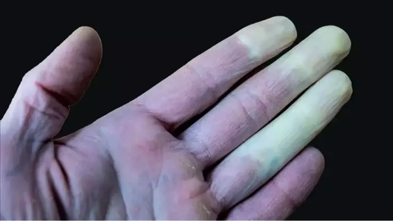 Tek belirtisi olan hastalık! El ve ayaklarda ortaya çıkıyor, mavi-mor renk değişimine dikkat