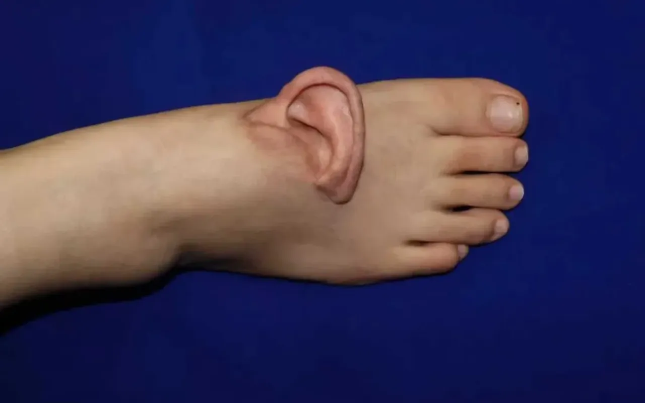 Tıp tarihine geçen kulak operasyonunda yeni gelişme! Ayağa dikilen kulak yerine başarıyla nakledildi