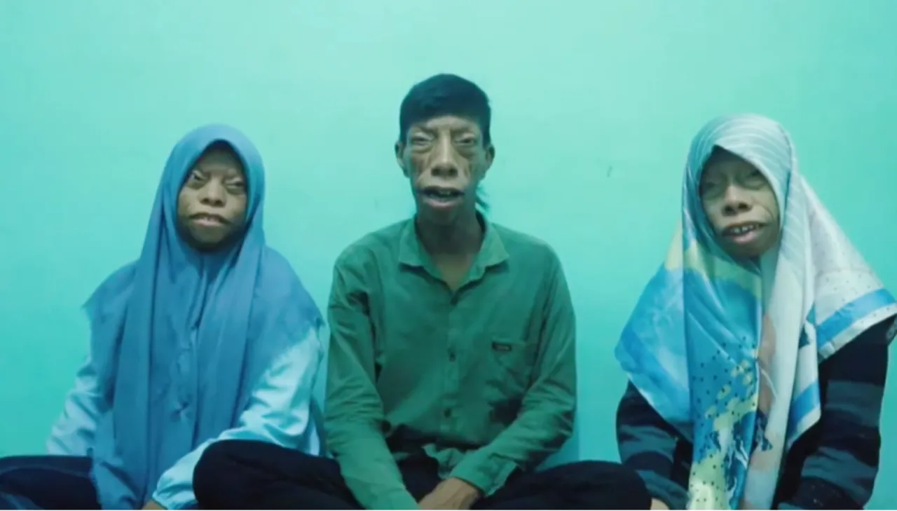 Fenomen Kertenkele Ailesiyle yeniden gündemde! Treacher Collins sendromu nedir?