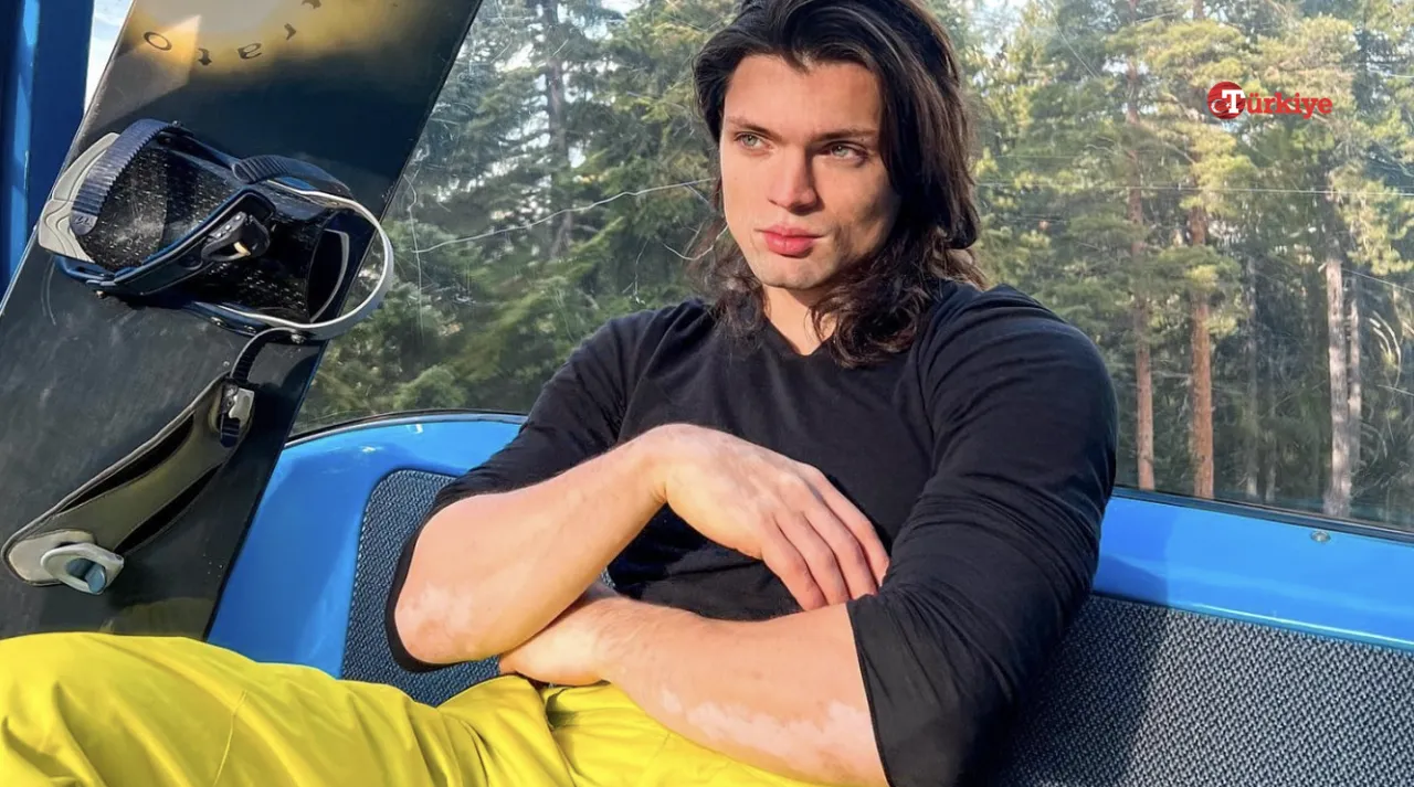 Survivor Onur Alp Çam’ın hastalığı (vitiligo) nedir, ellerinde ne var?